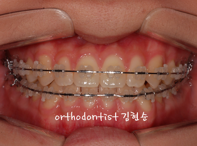 반대 교합 관련 이미지 20