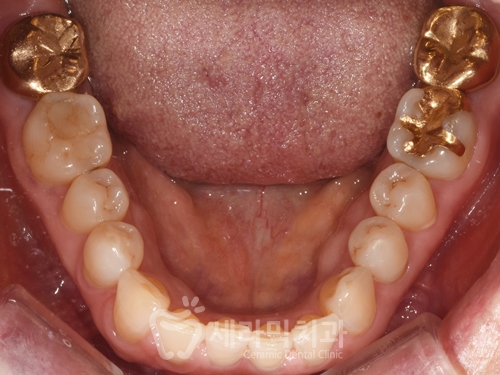 40대에 이어 50대 치아교정 전후사례 증가 추세 관련 이미지 9