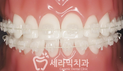 세라믹교정 잘하는 곳은? 세라믹치과 관련 이미지 2