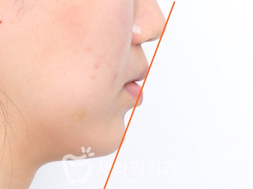혀내밀기 습관과 개방교합, 오픈바이트(Open bite) 치아교정전후 보기 관련 이미지 4