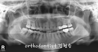 강남 덧니, 돌출 관련 이미지 33