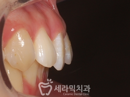돌출입교정은 무조건 4개 발치교정? NO! 옥니 없는 돌출입치아교정 관련 이미지 1