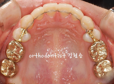 강남 돌출입 교정 관련 이미지 19