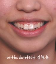 세라믹치과 "돌출입 발치교정" 관련 이미지 4