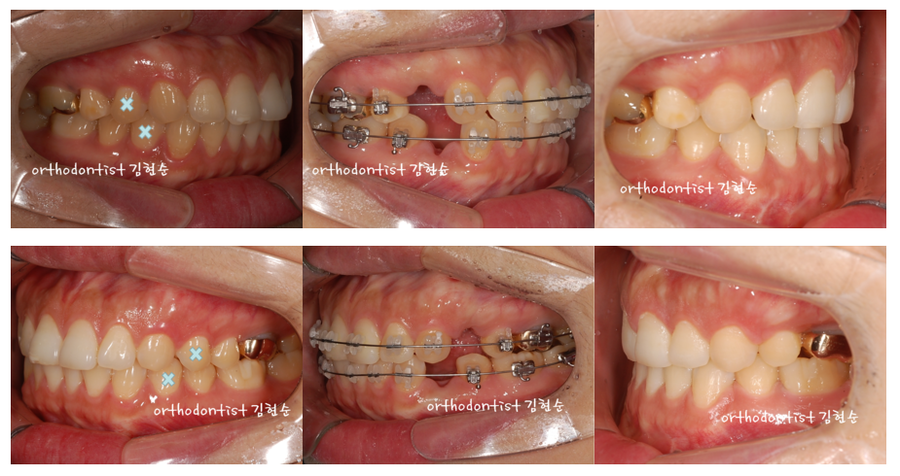 발치 돌출입교정으로 인상개선, 동안 만들기 관련 이미지 7