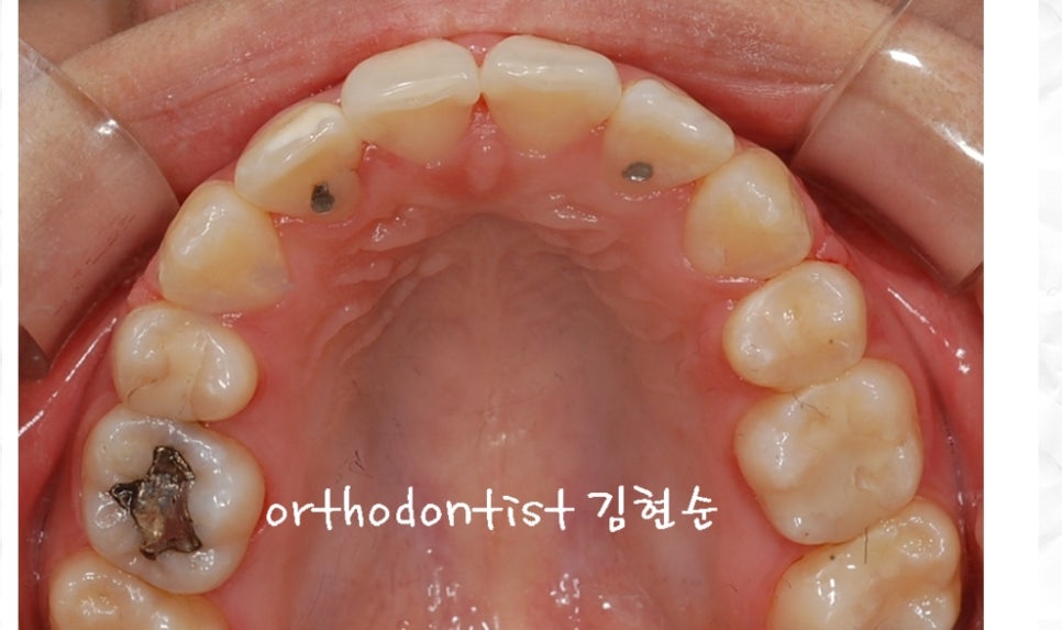 돌출입교정 / 기간 / 비용 관련 이미지 6