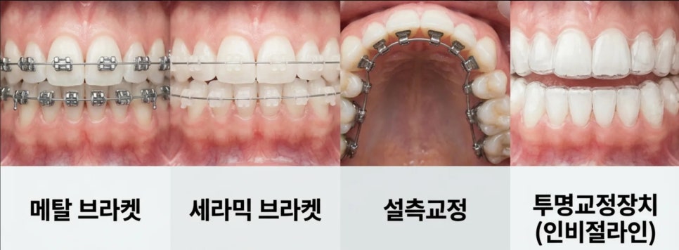 50대 치아교정 가능할까요? 기간과 부작용은? 관련 이미지 3