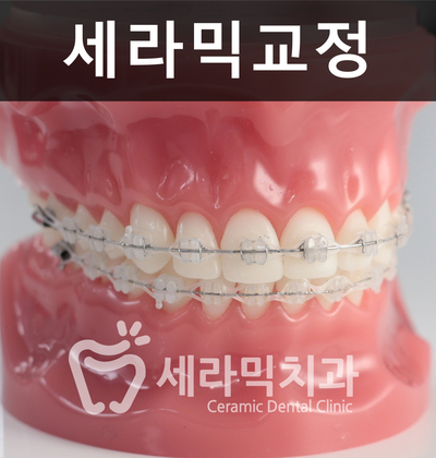 세라믹치과에서 세라믹교정이 인기있는 이유! 관련 이미지 4