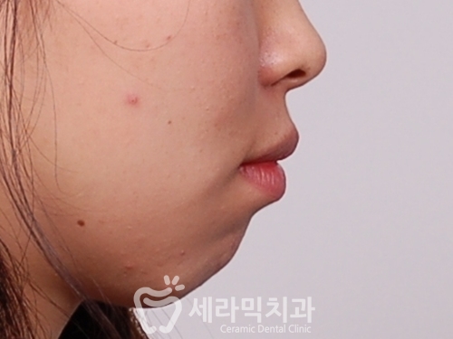 앞니 돌출, 개방교합으로 치아교정을 시작했는데, 작았던 아래턱이 커졌어요! 관련 이미지 1