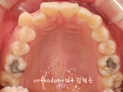 강남 돌출 (토끼 치아) 관련 이미지 7