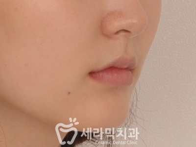 토끼이빨 돌출입 치아교정 전후 표정변화! 관련 이미지 16