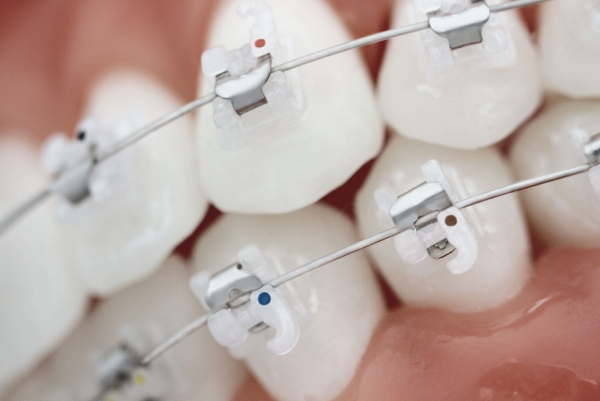 학동역치과 하면 세라믹교정 ~ 관련 이미지 7