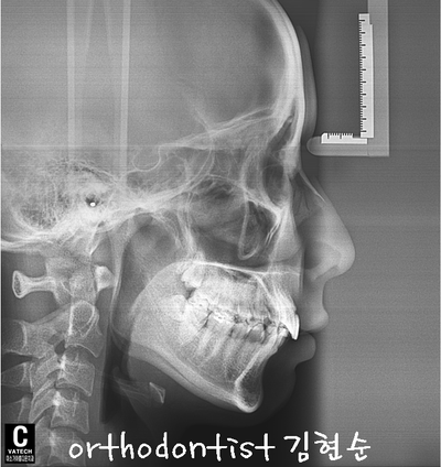 돌출 교정 (비발치 교정/비대칭) 관련 이미지 14