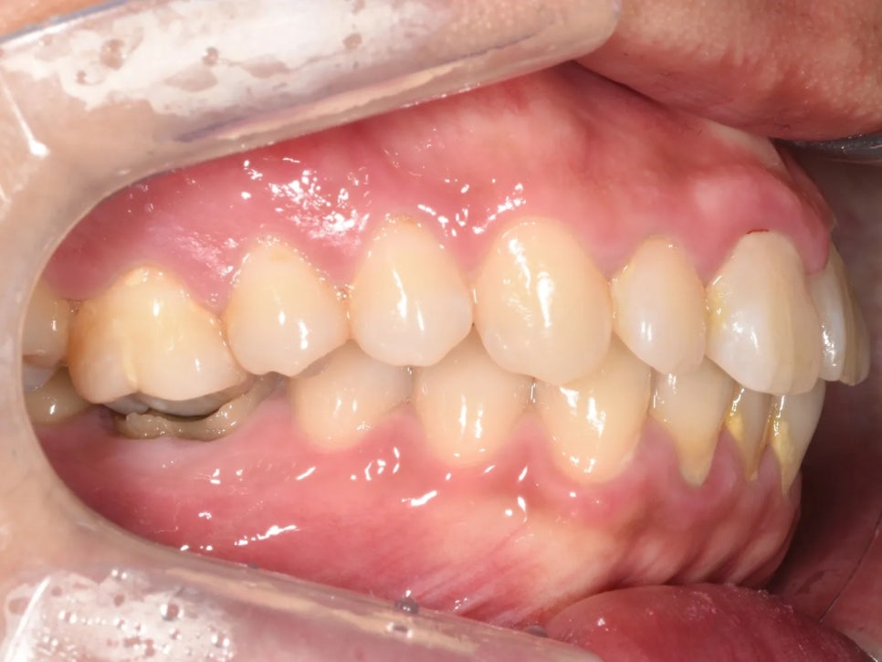 돌출입 교정 전후, 그런데 과개교합까지 있으셨던 환자분 관련 이미지 3