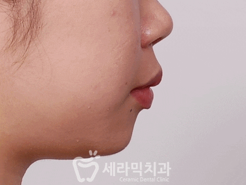 깨진 후에 후회하는 돌출입, 치아교정으로 건강하고 가지런한 치아만들기 관련 이미지 9