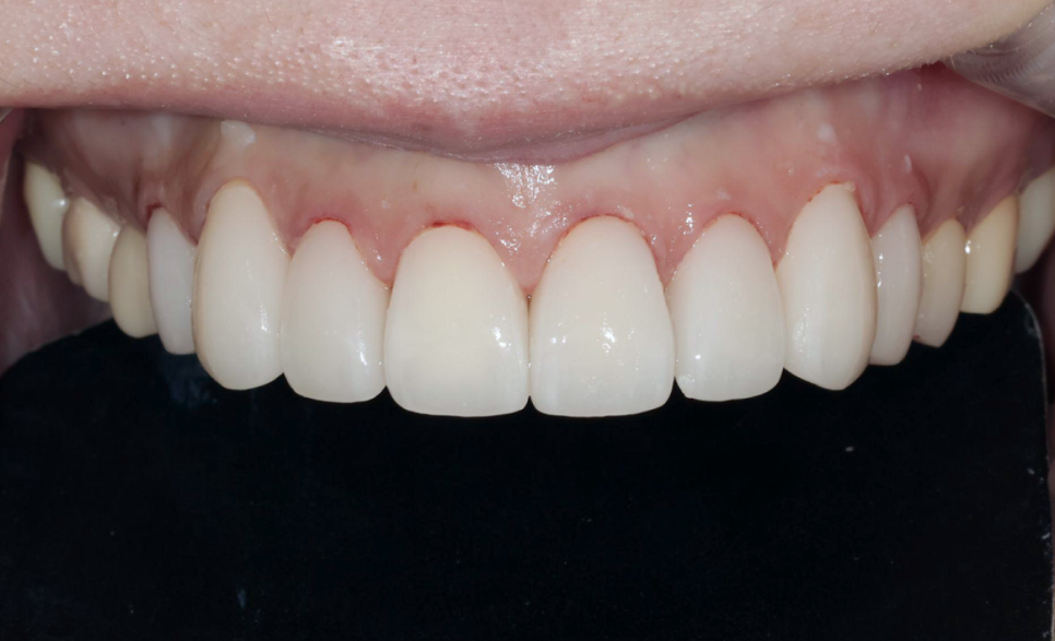 치아부식과 심미성을 동시에 잡은 앞니 치료 (ft. 역류성 식도염) 관련 이미지 10
