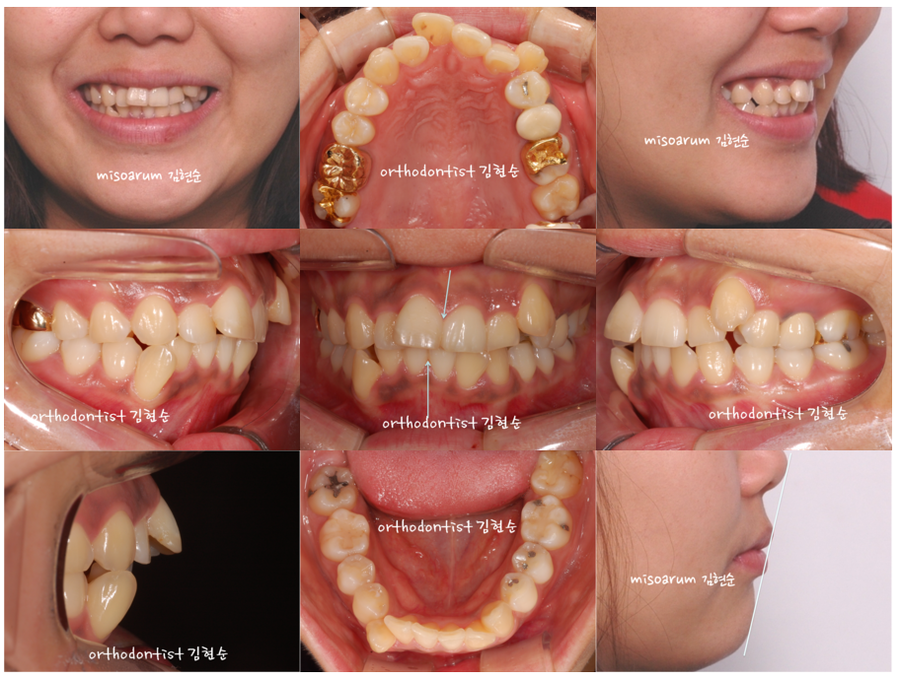 발치 교정으로 덧니 치열 올바로 잡기 관련 이미지 3