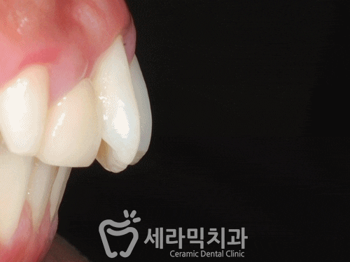 돌출입 투명교정 치아교정전후 관련 이미지 4