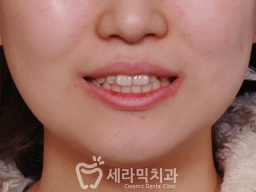 돌출입 치아교정전후. 몰라보게 달라진 얼굴변화 관련 이미지 2
