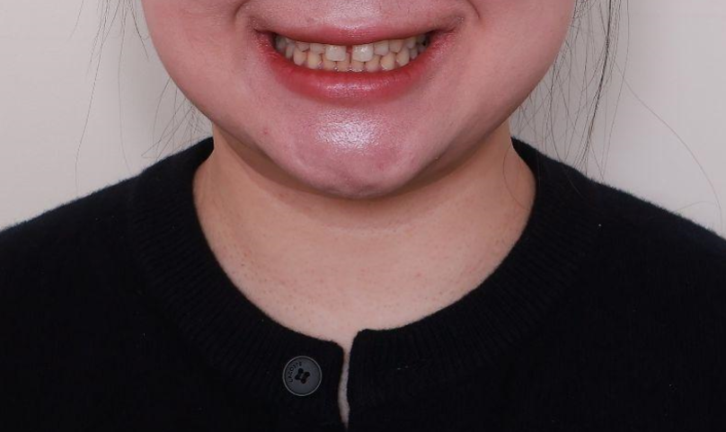 앞니 벌어짐, 교정 없이 라미네이트로 해결한 경우 관련 이미지 4