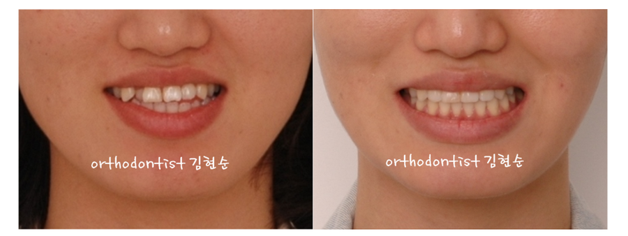 안면비대칭 교정, 치아교정만으로 간단히 해결하기 관련 이미지 19