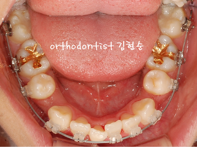 강남 덧니 관련 이미지 21