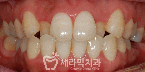 돌출입, 치열불규칙, 치아상실 치아교정과 임플란트 전후 관련 이미지 5