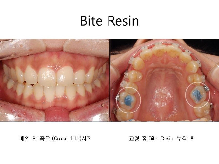 학동역치과 치아교정 잘하는 곳 ! 관련 이미지 15