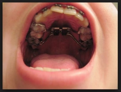 안면비대칭 치료 치아교정으로만 가능한 경우 관련 이미지 3