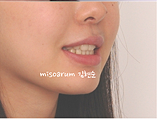 강남 돌출입 교정 관련 이미지 18