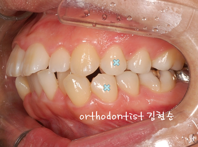강남 돌출 관련 이미지 17