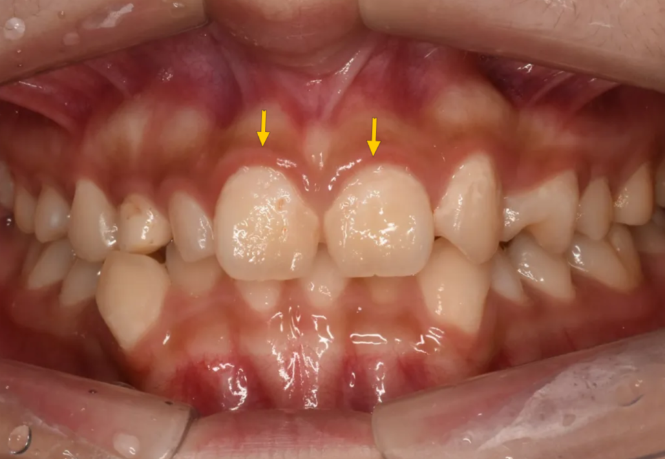 왜소치, 결손치가 동시에 있었던 환자의 앞니 심미보철 관련 이미지 8