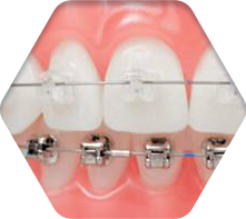 세라믹교정 세라믹치과 클리피씨교정 이야기 관련 이미지 7