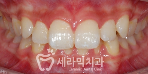 청소년교정 10대교정 딥바이트 과개교합 치아교정전후 관련 이미지 2