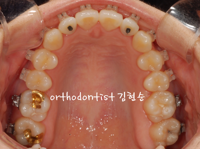 개방 교합 관련 이미지 22