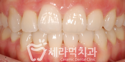 치아교정 전후 스마일라인 변화!(돌출입,토끼앞니, 중심선 비대칭 동시 교정) 관련 이미지 12