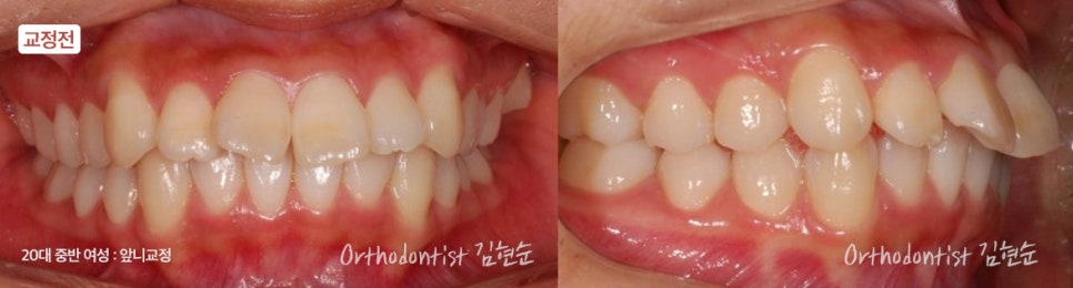 강남치아교정 브라켓비교분석 관련 이미지 16