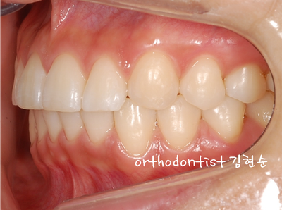 돌출 교정 (비발치 교정/비대칭) 관련 이미지 30