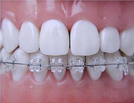 강남 세라믹 교정 관련 이미지 12