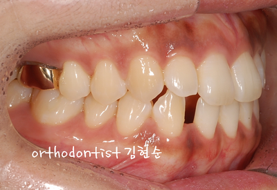 치열 교정 ( 벌어짐 ) 관련 이미지 9