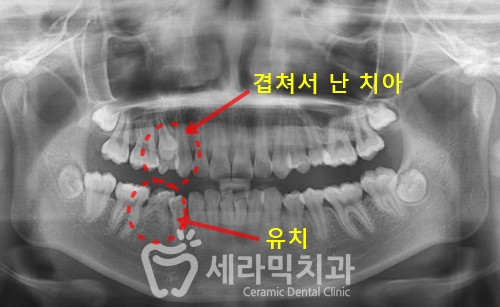 돌출입교정, 심미성과 치아 건강을 동시에 해결! 관련 이미지 19