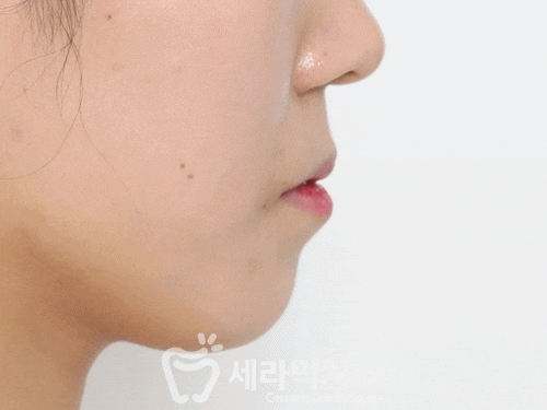 돌출입과 치아배열 치아교정전후 관련 이미지 1
