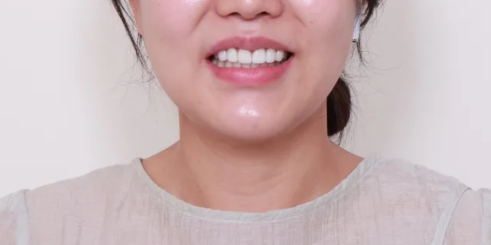 재교정에도 안 없어진 블랙 트라이앵글 치료, 라미네이트로 해결한 케이스 관련 이미지 7