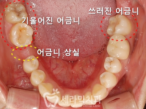 깨진 후에 후회하는 돌출입, 치아교정으로 건강하고 가지런한 치아만들기 관련 이미지 4