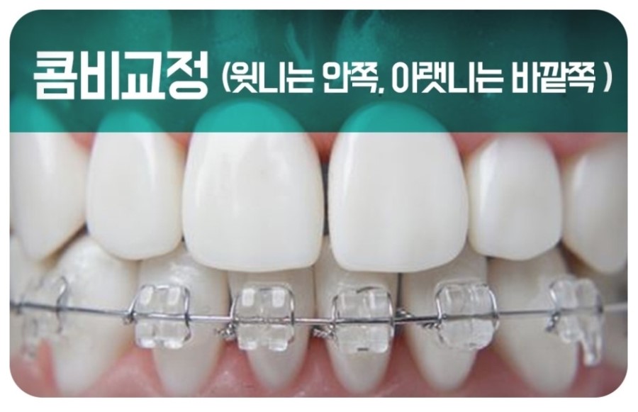 세라믹교정 클리피씨 데이몬 차이점 요약 관련 이미지 16