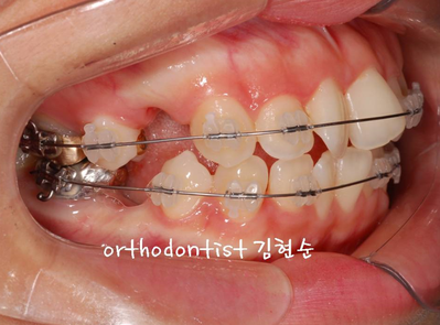 강남 돌출입 교정 관련 이미지 13