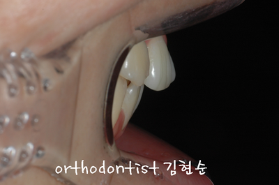 강남 돌출 관련 이미지 5