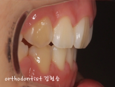 강남치아교정추천 관련 이미지 19