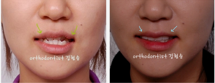 강남 덧니 관련 이미지 17