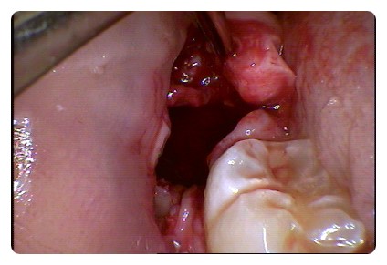 학동역 사랑니발치 관련 이미지 7